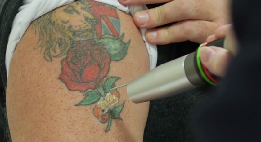 Effective Method Laser Tattoo Removal - DERMACARE™ Aesthetic & Laser Clinic