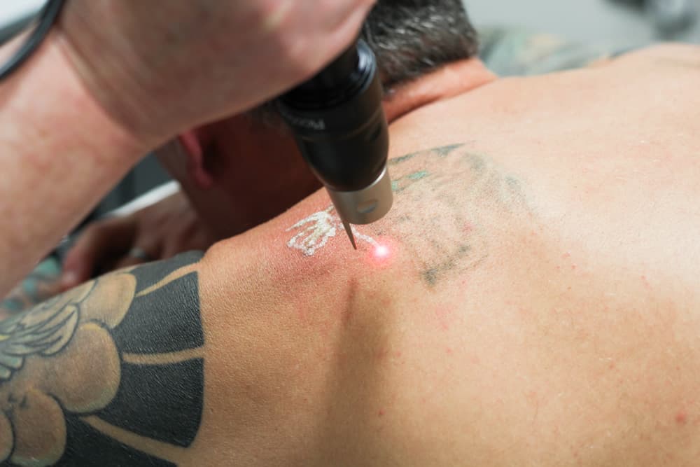 Tattoo removal at metro Atlanta clinic stirs relief nostalgia and  sometimes tears