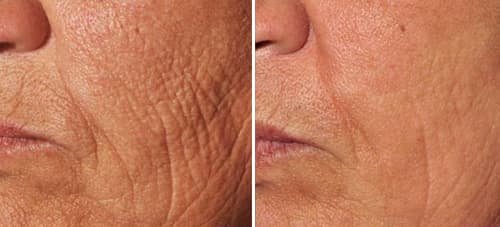 Laser Treatment For Wrinkles And Fine Lines Picosure Fla For Wrinkles