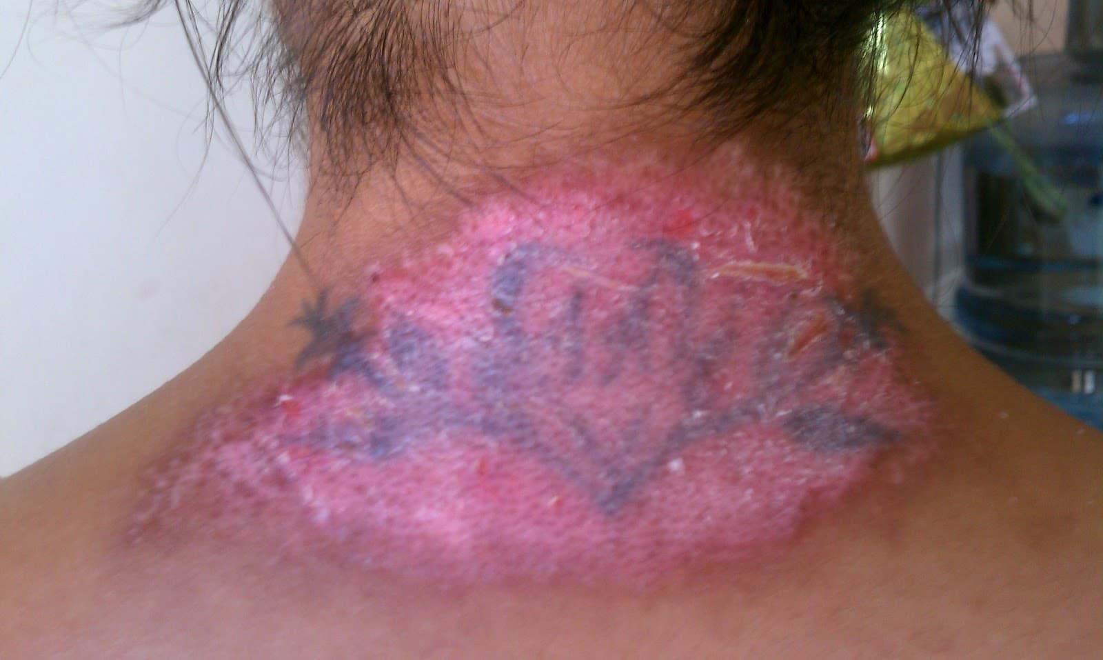 Laser Tattoo Removal  Schweiger Dermatology Group