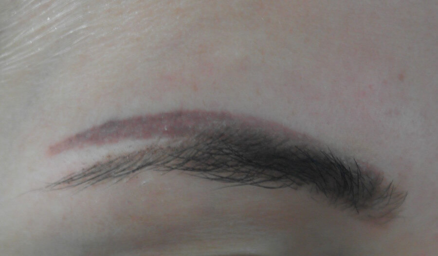 Eyebrow tattoo removal PicoSure after ND YAG, ink turned brighter red  (Photo)