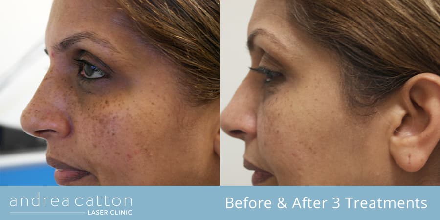 Laser Freckle Removal Uk Picosure Fla And Revlite Andrea Catton Laser Clinic 