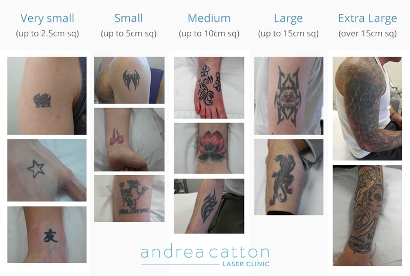 PicoSure® Tattoo Removal UK Andrea Catton Laser Clinic, Burnley
